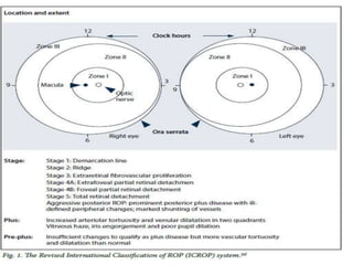 Retinopathy of prematurity | PPTX
