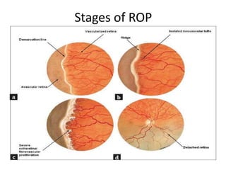 Retinopathy of prematurity | PPTX