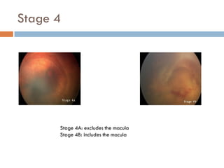 Retinopathy of prematurity | PDF