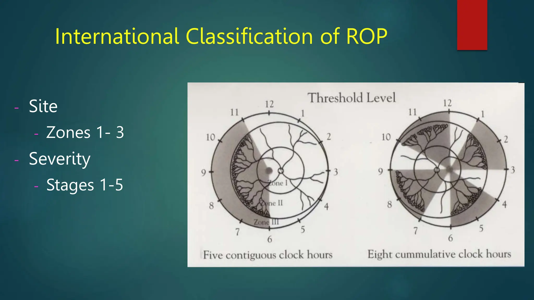 Retinopathy of prematurity for medical students.pptx