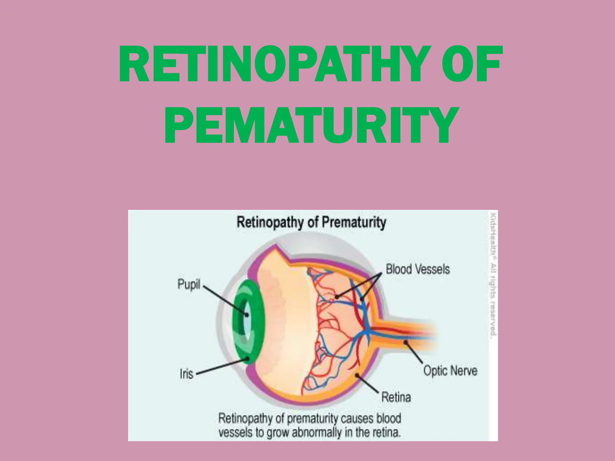 Retinopathy of prematurity.pdf ROP newborn | PDF