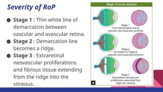 Vascular Ridge Rop Comprehensive Overview of Retinopathy of Prematurity: Screening ...