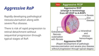 Agressive Rop Comprehensive Overview of Retinopathy of Prematurity: Screening ...