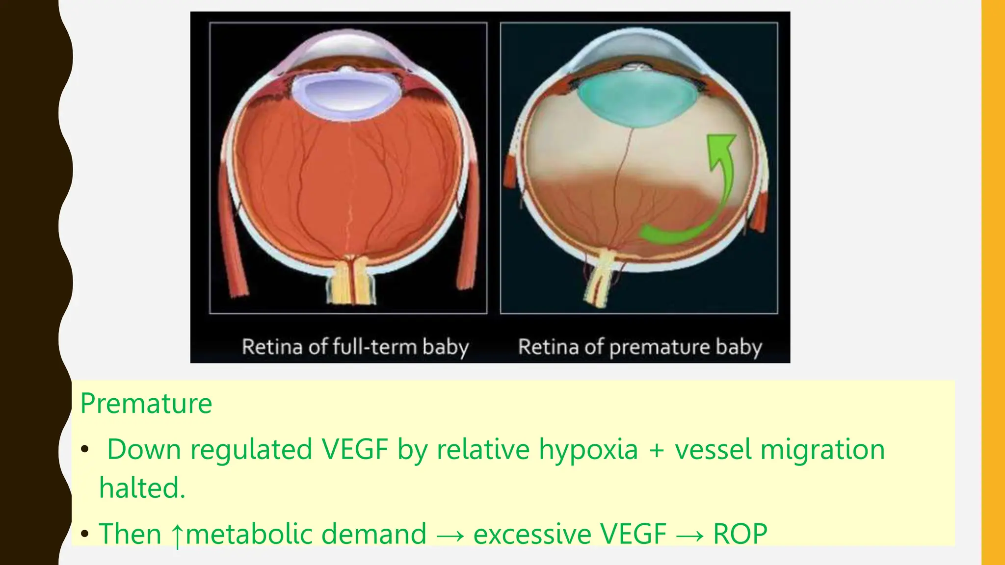 Premature
• Down regulated VEGF by relative hypoxia + vessel migration
halted.
• Then ↑metabolic demand → excessive VEGF → ROP
 