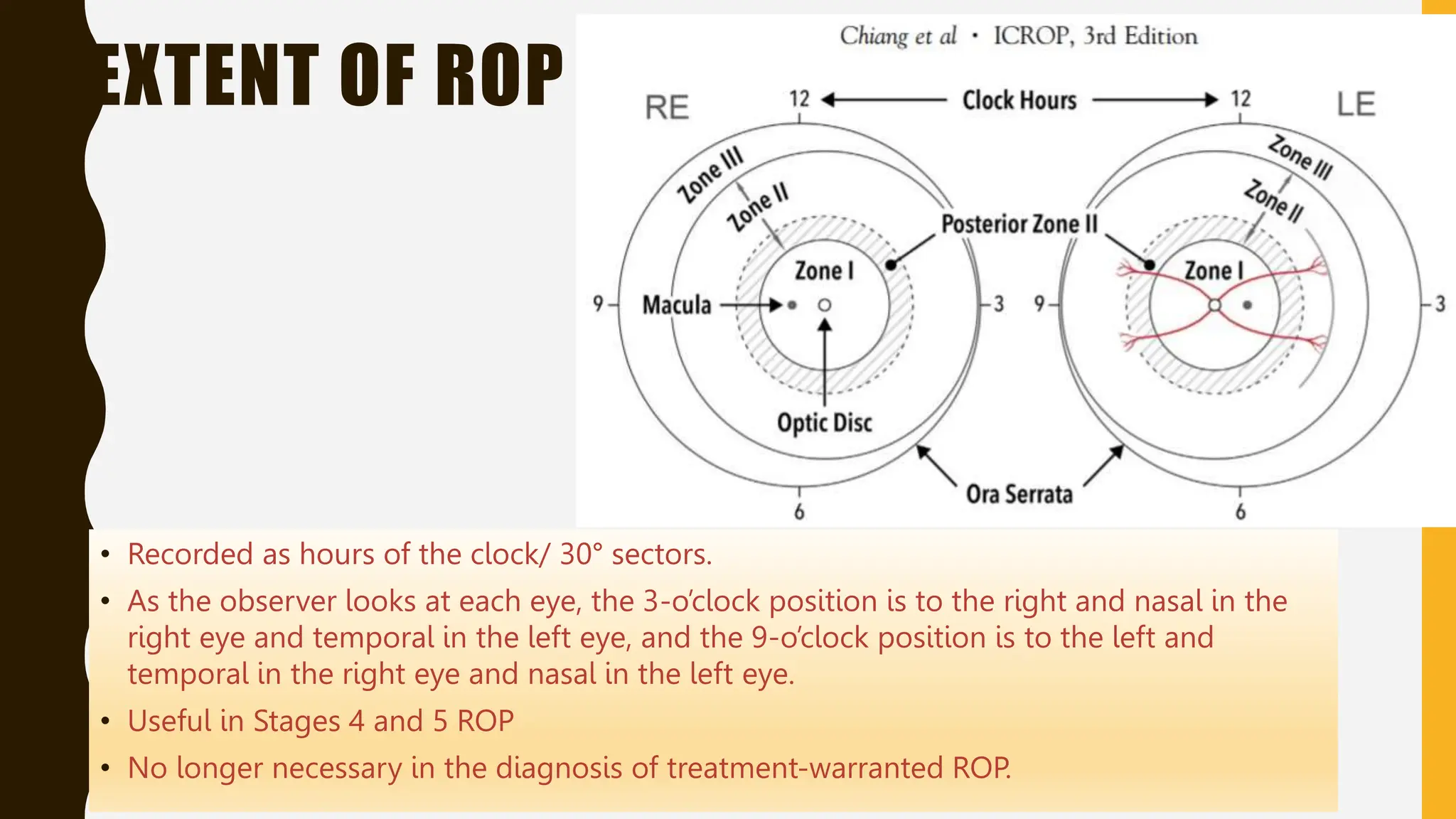EXTENT OF ROP
• Recorded as hours of the clock/ 30° sectors.
• As the observer looks at each eye, the 3-o’clock position is to the right and nasal in the
right eye and temporal in the left eye, and the 9-o’clock position is to the left and
temporal in the right eye and nasal in the left eye.
• Useful in Stages 4 and 5 ROP
• No longer necessary in the diagnosis of treatment-warranted ROP.
 