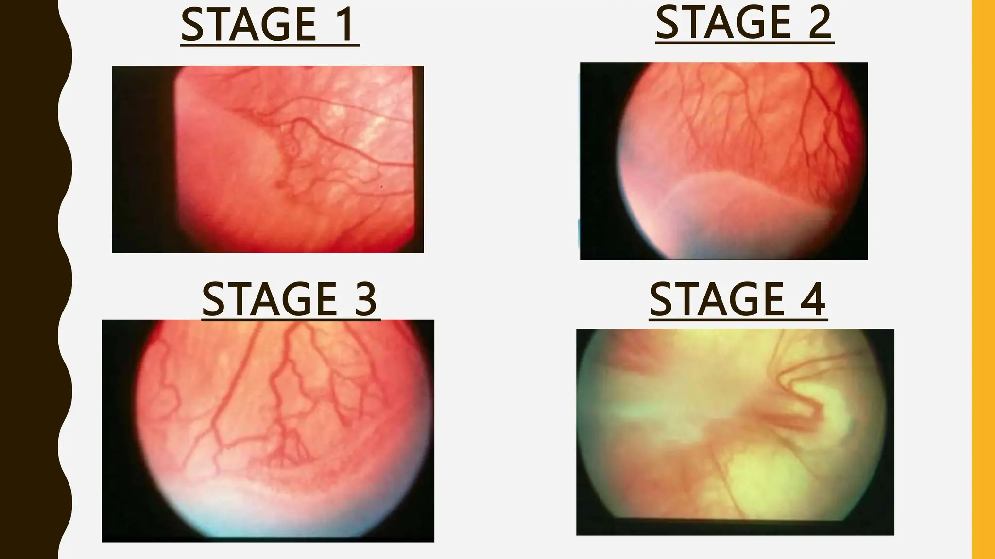 STAGE 2
STAGE 1
STAGE 4
STAGE 3
 