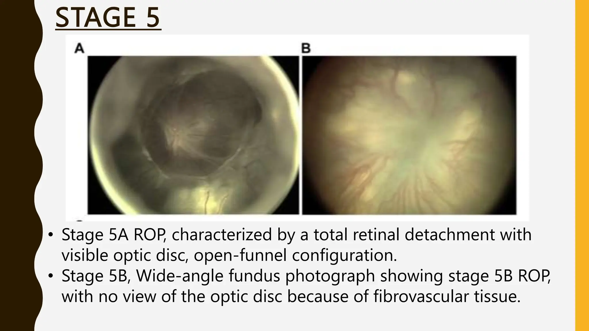 STAGE 5
• Stage 5A ROP, characterized by a total retinal detachment with
visible optic disc, open-funnel configuration.
• Stage 5B, Wide-angle fundus photograph showing stage 5B ROP,
with no view of the optic disc because of fibrovascular tissue.
 