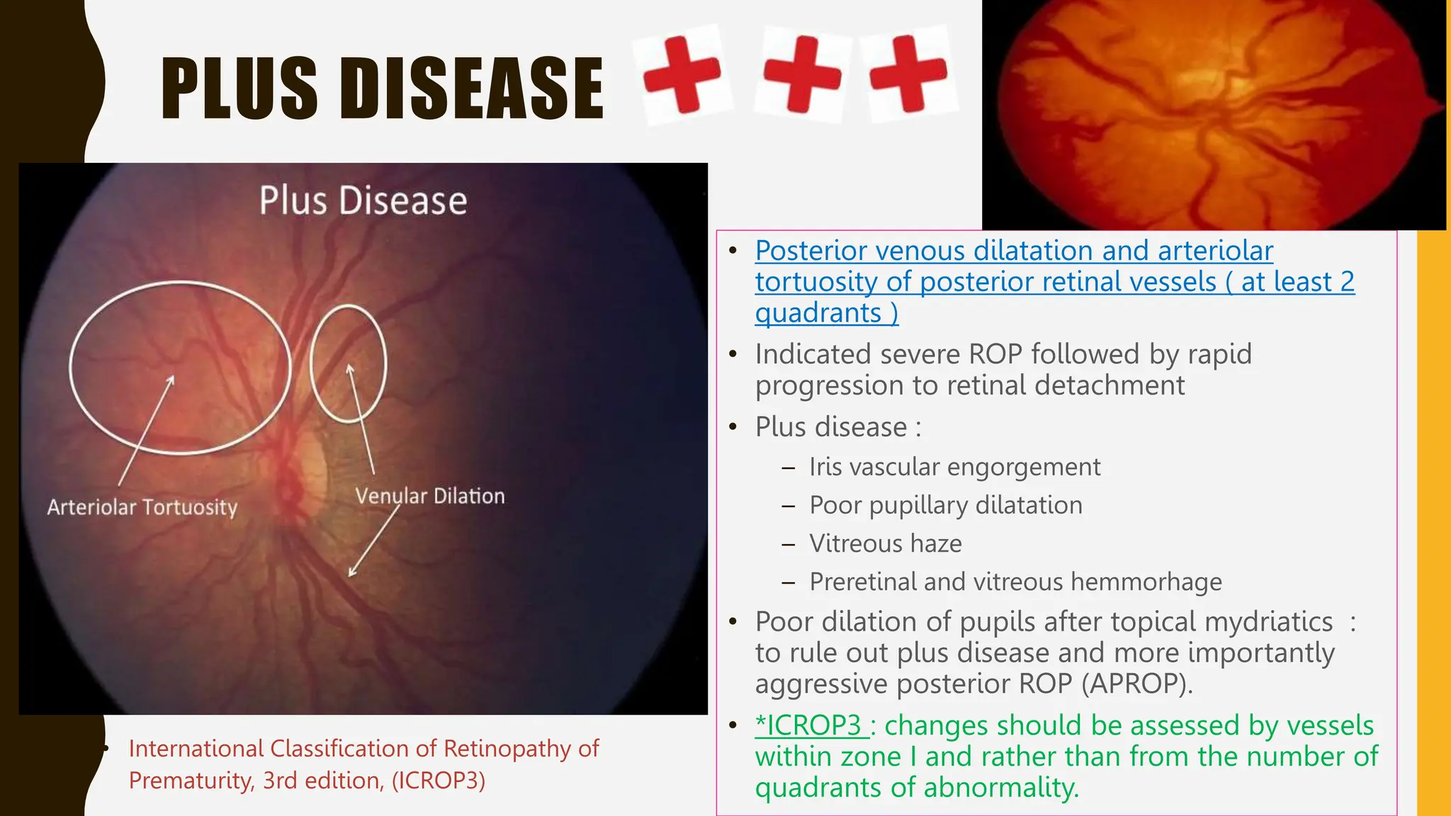 PLUS DISEASE
• Posterior venous dilatation and arteriolar
tortuosity of posterior retinal vessels ( at least 2
quadrants )
• Indicated severe ROP followed by rapid
progression to retinal detachment
• Plus disease :
– Iris vascular engorgement
– Poor pupillary dilatation
– Vitreous haze
– Preretinal and vitreous hemmorhage
• Poor dilation of pupils after topical mydriatics :
to rule out plus disease and more importantly
aggressive posterior ROP (APROP).
• *ICROP3 : changes should be assessed by vessels
within zone I and rather than from the number of
quadrants of abnormality.
• International Classification of Retinopathy of
Prematurity, 3rd edition, (ICROP3)
 