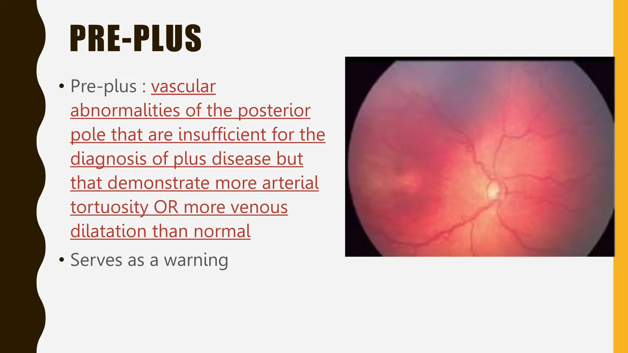 PRE-PLUS
• Pre-plus : vascular
abnormalities of the posterior
pole that are insufficient for the
diagnosis of plus disease but
that demonstrate more arterial
tortuosity OR more venous
dilatation than normal
• Serves as a warning
 