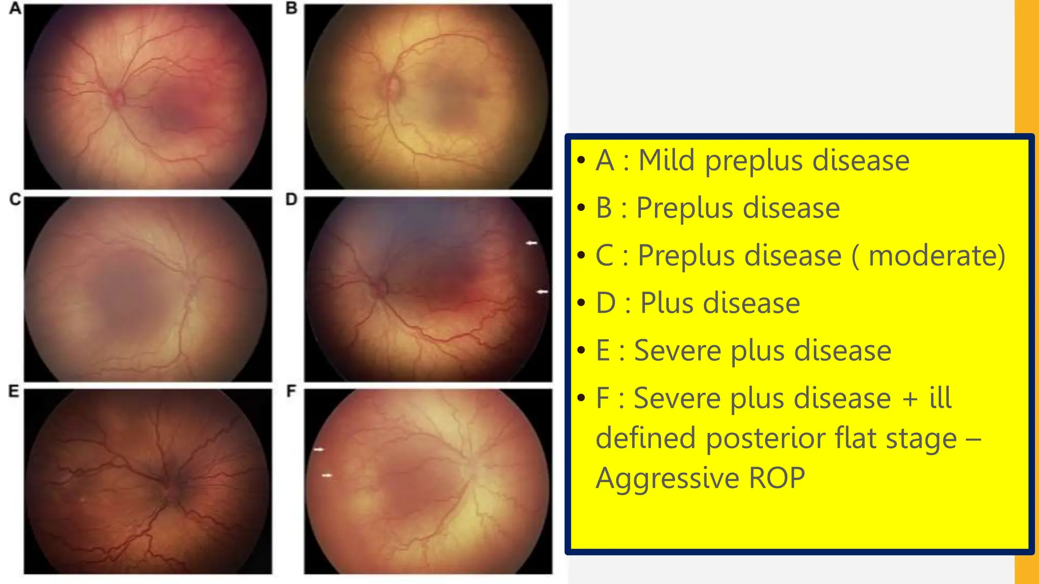 • A : Mild preplus disease
• B : Preplus disease
• C : Preplus disease ( moderate)
• D : Plus disease
• E : Severe plus disease
• F : Severe plus disease + ill
defined posterior flat stage –
Aggressive ROP
 