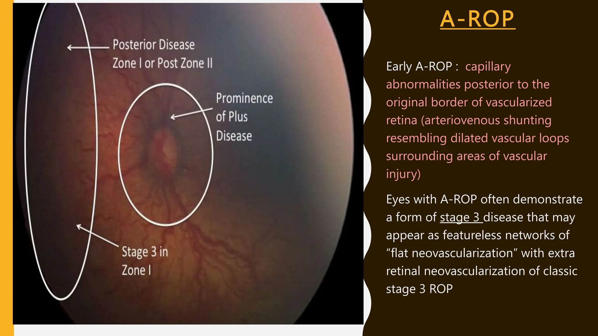 A-ROP
Early A-ROP : capillary
abnormalities posterior to the
original border of vascularized
retina (arteriovenous shunting
resembling dilated vascular loops
surrounding areas of vascular
injury)
Eyes with A-ROP often demonstrate
a form of stage 3 disease that may
appear as featureless networks of
“flat neovascularization” with extra
retinal neovascularization of classic
stage 3 ROP
 