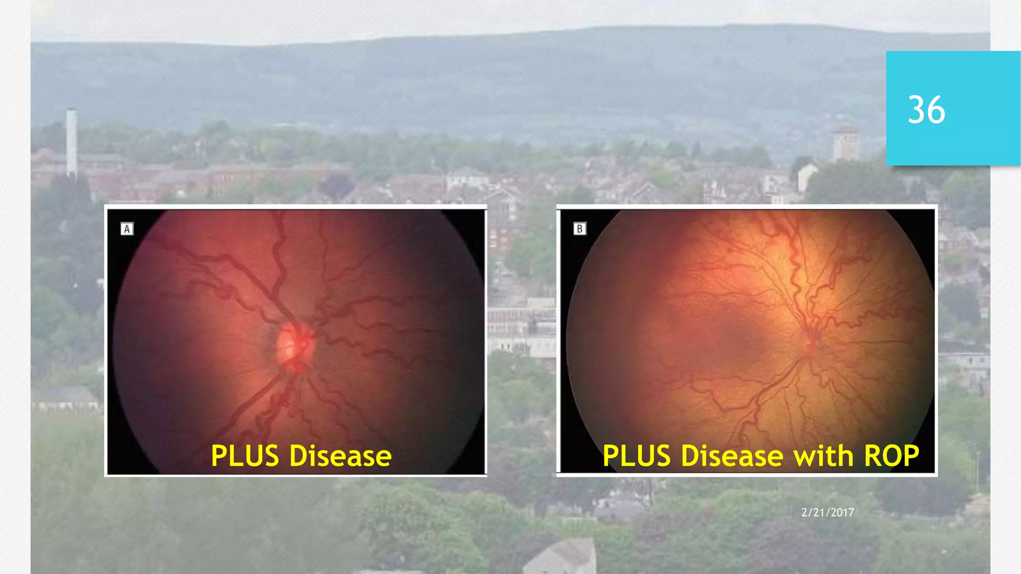 Retinopathy of prematurity rop satish 1 | PPT