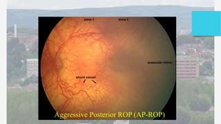 Retinopathy of prematurity rop satish 1 | PPTX