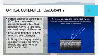 Oct Modality Retinopathy of prematurity rop satish 1 | PPTX