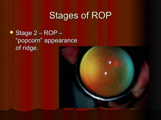 Vascular Ridge Rop Retinopathy of prematurity (upload for site) | PPT