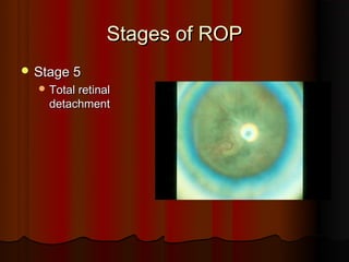 Retinopathy of prematurity (upload for site) | PPT