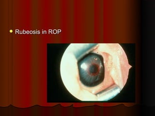 Negative Rubeosis Retinopathy of prematurity (upload for site) | PPT