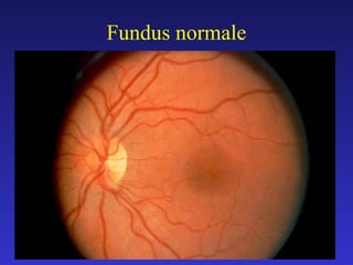 Fundus normale

 