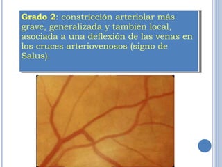 Grado 2 : constricción arteriolar más grave, generalizada y también local, asociada a una deflexión de las venas en los cruces arteriovenosos (signo de Salus).   