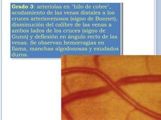 Grado 3 : arteriolas en "hilo de cobre", acodamiento de las venas distales a los cruces arteriovenosos (signo de Bonnet), disminución del calibre de las venas a ambos lados de los cruces (signo de Gunn) y deflexión en ángulo recto de las venas. Se observan hemorragias en llama, manchas algodonosas y exudados duros. 