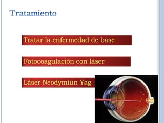 Tratar la enfermedad de base Fotocoagulación con láser  Láser Neodymiun Yag  