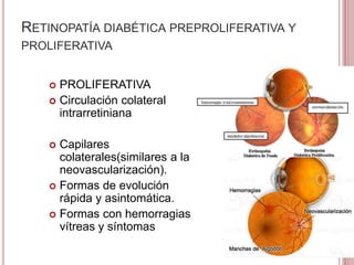 RETINOPATÍA DIABÉTICA PREPROLIFERATIVA Y 
PROLIFERATIVA 
 PROLIFERATIVA 
 Circulación colateral 
intrarretiniana 
 Capilares 
colaterales(similares a la 
neovascularización). 
 Formas de evolución 
rápida y asintomática. 
 Formas con hemorragias 
vítreas y síntomas 
 