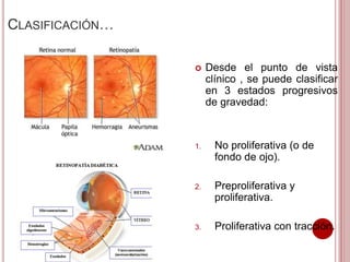 CLASIFICACIÓN… 
 Desde el punto de vista 
clínico , se puede clasificar 
en 3 estados progresivos 
de gravedad: 
1. No proliferativa (o de 
fondo de ojo). 
2. Preproliferativa y 
proliferativa. 
3. Proliferativa con tracción. 
 