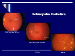 MR Cano  Retinopatia Diabética microaneurismas neovascularizacion DME 
