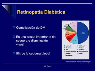 Complicación de DM Es una causa importante de ceguera e disminución visual  5% de la ceguera global MR Cano  Retinopatía  Diabética www.revoptom.com/publish/images 