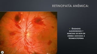 • EXUDADOS
ALGODONOSOS Y
MANCHAS DE ROTH EN
ANEMIA ASOCIADA A
TROMBOCITOPENIA
RETINOPATÍA ANÉMICA:
 