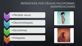 •Pérdida visual.
•Discromatopsia.
•Escotomas.
•Fotopsias.
RETINOPATÍA POR CÉLULAS FALCIFORMES:
MANIFESTACIONES
 
