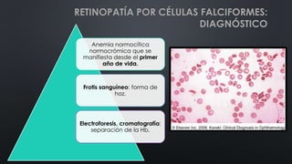 Anemia normocítica
normocrómica que se
manifiesta desde el primer
año de vida.
Frotis sanguíneo: forma de
hoz.
Electroforesis, cromatografía:
separación de la Hb.
RETINOPATÍA POR CÉLULAS FALCIFORMES:
DIAGNÓSTICO
 
