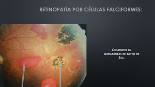 • CICATRICES EN
QUEMADURAS DE RAYOS DE
SOL.
RETINOPATÍA POR CÉLULAS FALCIFORMES:
 