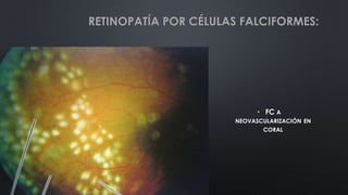 • FC A
NEOVASCULARIZACIÓN EN
CORAL
RETINOPATÍA POR CÉLULAS FALCIFORMES:
 