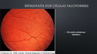 • OCLUSIÓN ARTERIOLAR
PERIFÉRICA
RETINOPATÍA POR CÉLULAS FALCIFORMES:
 