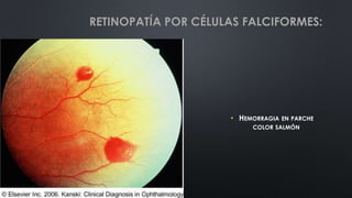• HEMORRAGIA EN PARCHE
COLOR SALMÓN
RETINOPATÍA POR CÉLULAS FALCIFORMES:
 