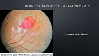 • PARCHE COLOR SALMÓN
RETINOPATÍA POR CÉLULAS FALCIFORMES:
 