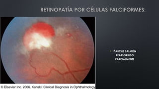 • PARCHE SALMÓN
REABSORBIDO
PARCIALMENTE
RETINOPATÍA POR CÉLULAS FALCIFORMES:
 
