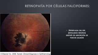 • HIPERPLASIA DEL EPR
(ESTALLIDOS NEGROS)
DESPUÉS DE ABSORCIÓN DE
PARCHE SALMÓN
RETINOPATÍA POR CÉLULAS FALCIFORMES:
 