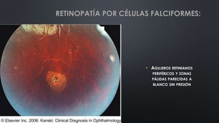 • AGUJEROS RETINIANOS
PERIFÉRICOS Y ZONAS
PÁLIDAS PARECIDAS A
BLANCO SIN PRESIÓN
RETINOPATÍA POR CÉLULAS FALCIFORMES:
 