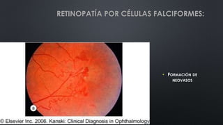 • FORMACIÓN DE
NEOVASOS
RETINOPATÍA POR CÉLULAS FALCIFORMES:
 