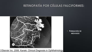 • FORMACIÓN DE
NEOVASOS
RETINOPATÍA POR CÉLULAS FALCIFORMES:
 