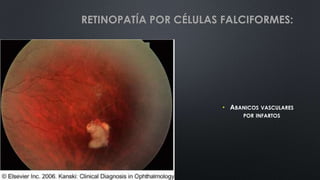 • ABANICOS VASCULARES
POR INFARTOS
RETINOPATÍA POR CÉLULAS FALCIFORMES:
 