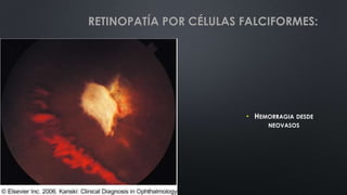• HEMORRAGIA DESDE
NEOVASOS
RETINOPATÍA POR CÉLULAS FALCIFORMES:
 