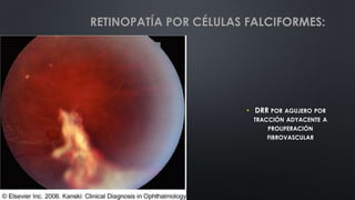 • DRR POR AGUJERO POR
TRACCIÓN ADYACENTE A
PROLIFERACIÓN
FIBROVASCULAR
RETINOPATÍA POR CÉLULAS FALCIFORMES:
 