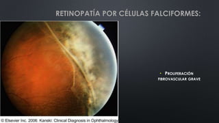 • PROLIFERACIÓN
FIBROVASCULAR GRAVE
RETINOPATÍA POR CÉLULAS FALCIFORMES:
 