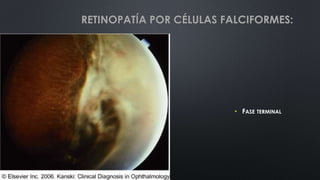 • FASE TERMINAL
RETINOPATÍA POR CÉLULAS FALCIFORMES:
 
