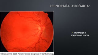 • DILATACIÓN Y
TORTUOSIDAD VENOSA
RETINOPATÍA LEUCÉMICA:
 