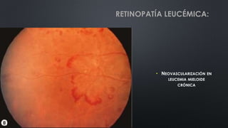 • NEOVASCULARIZACIÓN EN
LEUCEMIA MIELOIDE
CRÓNICA
RETINOPATÍA LEUCÉMICA:
 