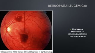• HEMORRAGIA
PRERRETINIANA Y
HEMORRAGIA RETINIANA
DE CENTRO BLANCO
RETINOPATÍA LEUCÉMICA:
 